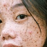 Spots - Close-Up Photography Of Woman's Face With Freckles