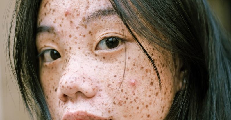 Spots - Close-Up Photography Of Woman's Face With Freckles